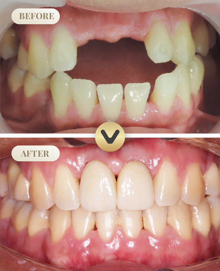 ภาพเปรียบเทียบก่อนและหลังทำรากฟันเทียมที่คลินิกหมอน้ำ Dental Square พัทยา