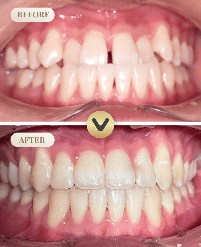 ภาพเปรียบเทียบก่อนและหลังจัดฟันใส Invisalign ที่คลินิกหมอน้ำ Dental Square พัทยา